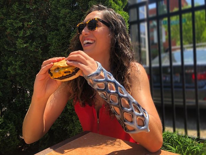 Engineers Create A Breathable And Waterproof Cast To Replace Plaster Ones And Stop The Itching Forever Engineers Create A Breathable And Waterproof Cast To Replace Plaster Ones And Stop The Itching Forever