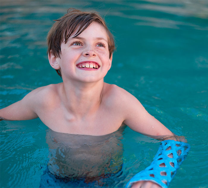 Engineers Create A Breathable And Waterproof Cast To Replace Plaster Ones And Stop The Itching Forever Engineers Create A Breathable And Waterproof Cast To Replace Plaster Ones And Stop The Itching Forever