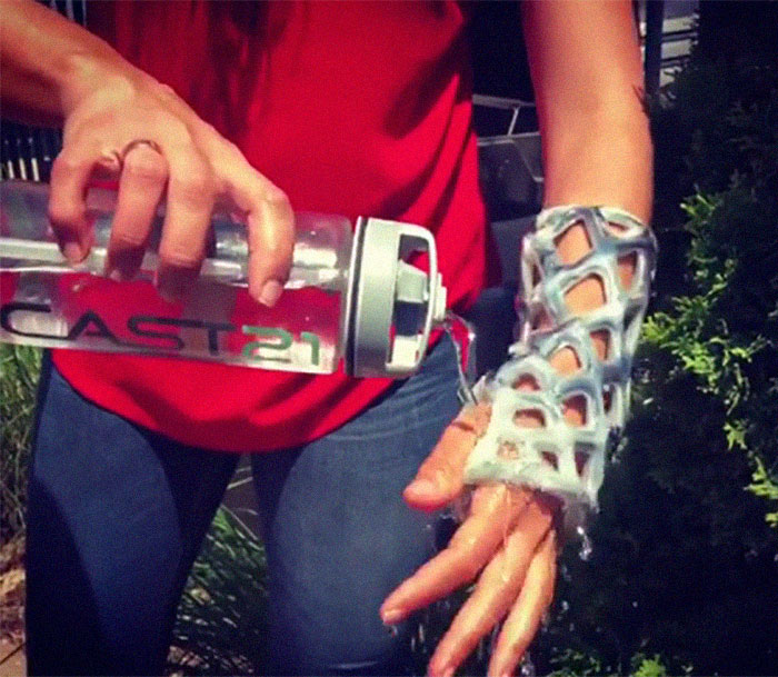 Engineers Create A Breathable And Waterproof Cast To Replace Plaster Ones And Stop The Itching Forever Engineers Create A Breathable And Waterproof Cast To Replace Plaster Ones And Stop The Itching Forever