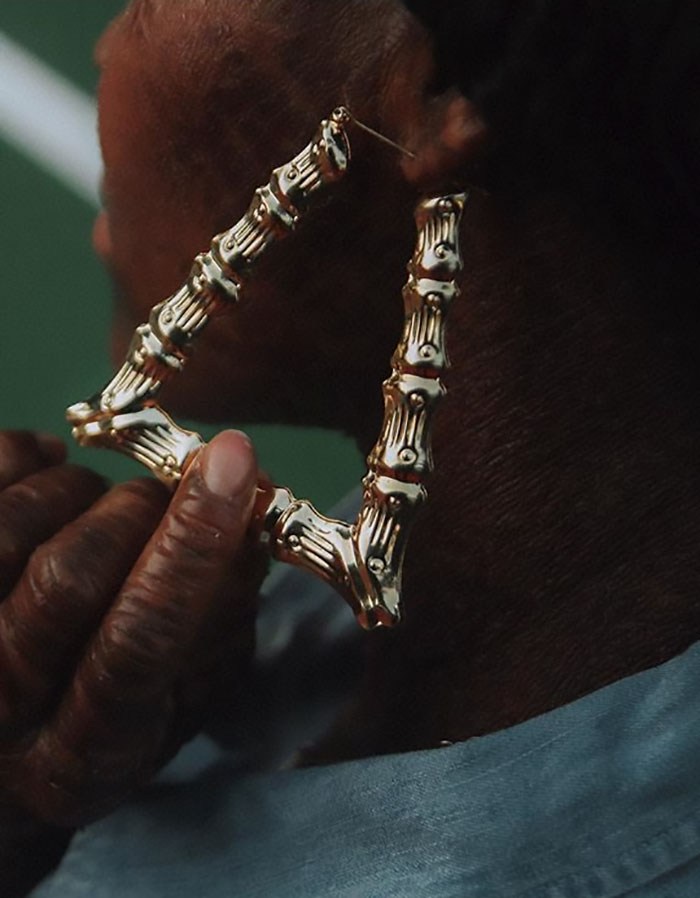 Woman Who Sheds Skin Every Two Weeks Becomes Probably The First Model Who Has This Condition