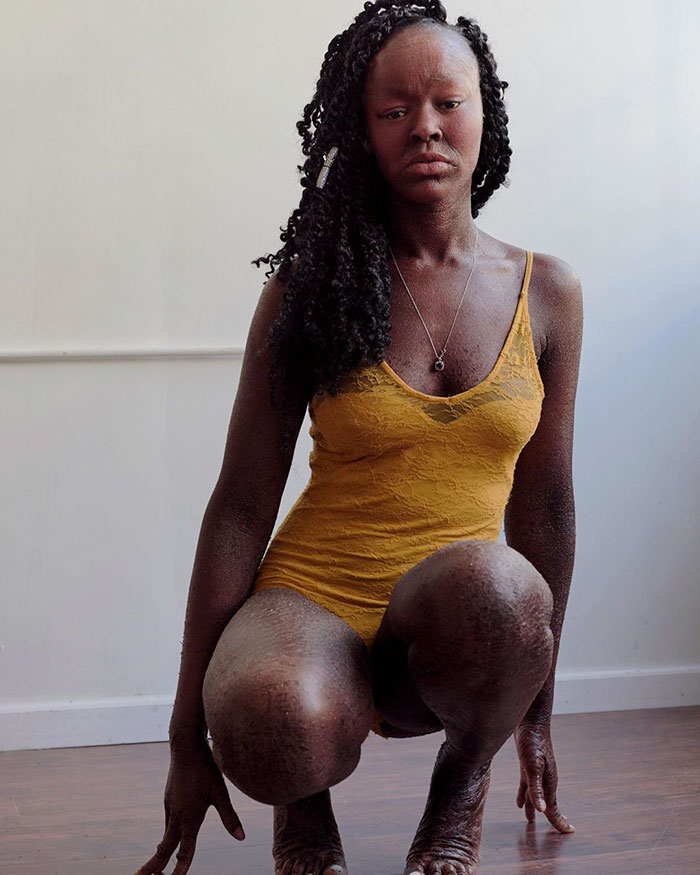 Woman Who Sheds Skin Every Two Weeks Becomes Probably The First Model Who Has This Condition