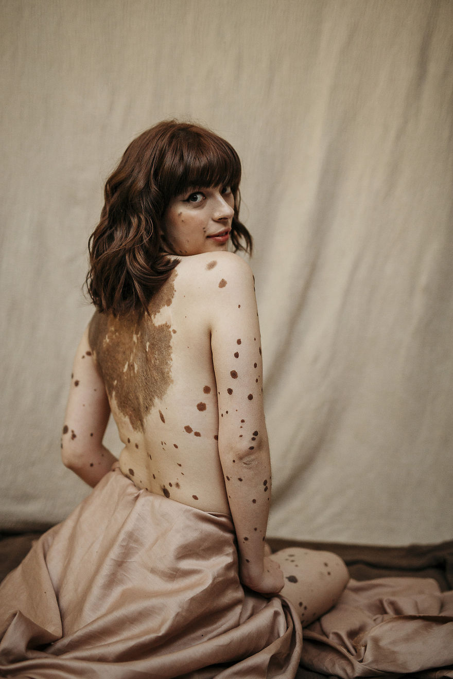 For This International Women‘s Day We Did A Special Photoshoot With Women That Represent People With Disabilities And Visible Differences For This International Women‘s Day We Did A Special Photoshoot With Women That Represent People With Disabilities And Visible Differences