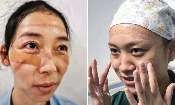 Chinese Nurses Share Pictures Of How Their Faces Look After Countless Hours Fighting The Coronavirus Chinese Nurses Share Pictures Of How Their Faces Look After Countless Hours Fighting The Coronavirus