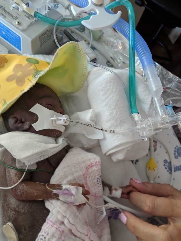 “I Adopted A ‘Perfect’ Micro-Preemie & Was By His Side As He Died 8 Days Later” “I Adopted A ‘Perfect’ Micro-Preemie & Was By His Side As He Died 8 Days Later”