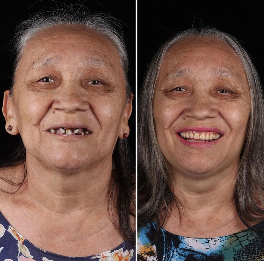 Brazilian Dentist Travels To Fix The Teeth Of Less-Fortunate People For Free And Here Are 30 New Transformations Brazilian Dentist Travels To Fix The Teeth Of Less-Fortunate People For Free And Here Are 30 New Transformations