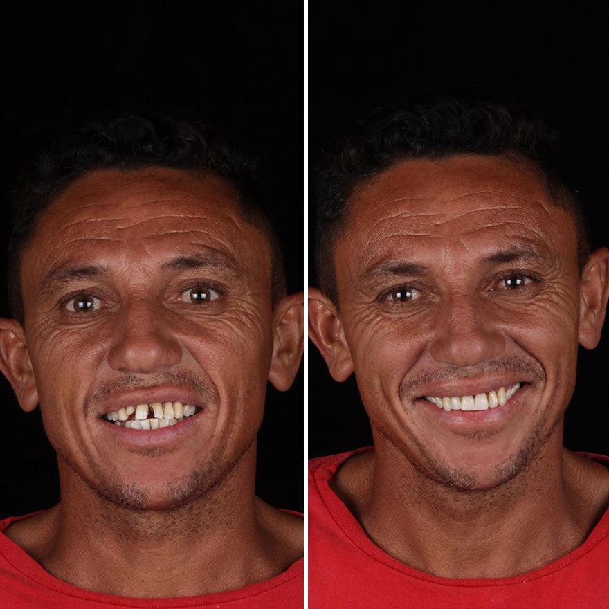 Brazilian Dentist Travels To Fix The Teeth Of Less-Fortunate People For Free And Here Are 30 New Transformations Brazilian Dentist Travels To Fix The Teeth Of Less-Fortunate People For Free And Here Are 30 New Transformations