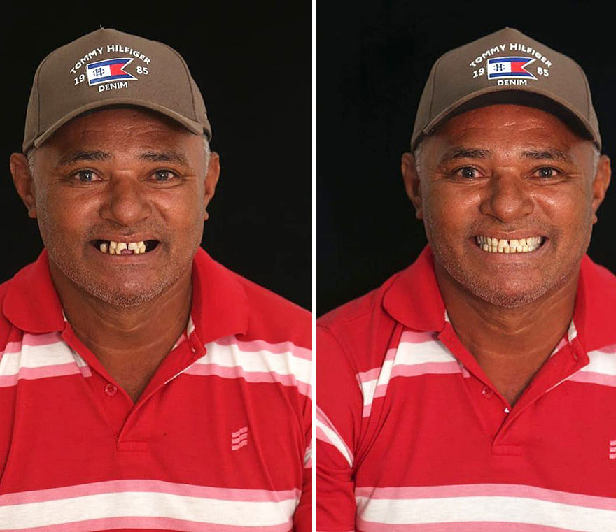 Brazilian Dentist Travels To Fix The Teeth Of Less-Fortunate People For Free And Here Are 30 New Transformations Brazilian Dentist Travels To Fix The Teeth Of Less-Fortunate People For Free And Here Are 30 New Transformations