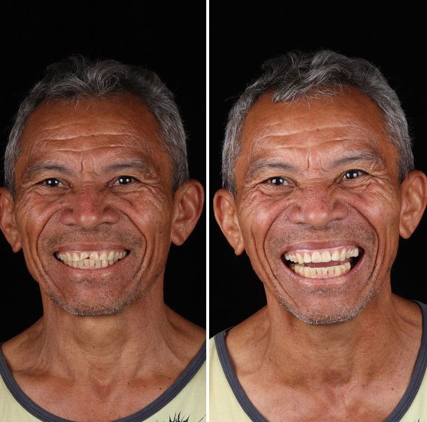 Brazilian Dentist Travels To Fix The Teeth Of Less-Fortunate People For Free And Here Are 30 New Transformations Brazilian Dentist Travels To Fix The Teeth Of Less-Fortunate People For Free And Here Are 30 New Transformations