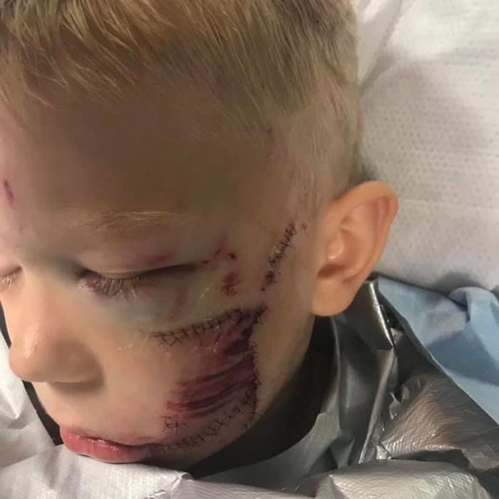 6-Year-Old Superhero Saves Sister From Dog Attack, Gets 90 Stitches And Praise From The Avengers 6-Year-Old Superhero Saves Sister From Dog Attack, Gets 90 Stitches And Praise From The Avengers
