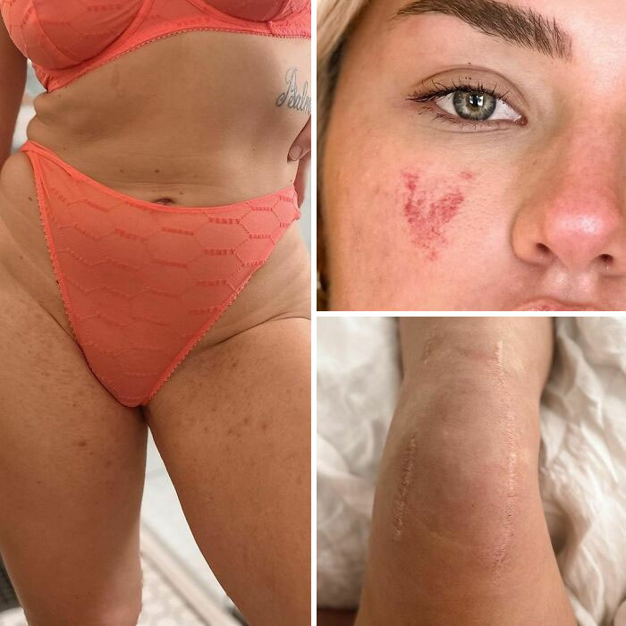 41 Women Post Unedited Pics To “Normalize Normal Bodies”