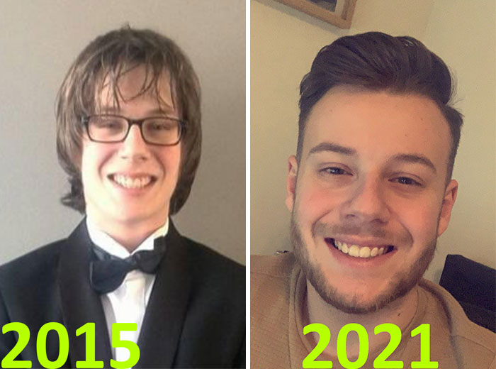 30 “Ugly Ducklings” Share Their Incredible Transformations Into Beautiful Swans (New Pics)