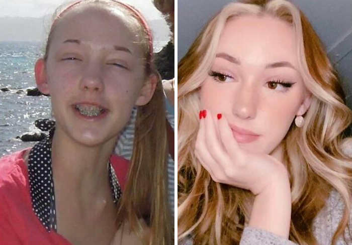 30 “Ugly Ducklings” Share Their Incredible Transformations Into Beautiful Swans (New Pics)