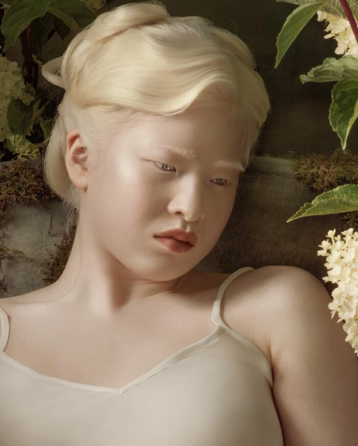 Abandoned As A Baby Due To Albinism, Xueli Grew Up To Become A Vogue Model (30 Pics) Abandoned As A Baby Due To Albinism, Xueli Grew Up To Become A Vogue Model (30 Pics)