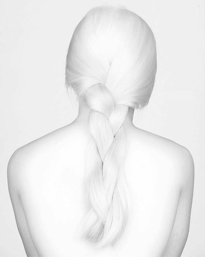 Abandoned As A Baby Due To Albinism, Xueli Grew Up To Become A Vogue Model (30 Pics) Abandoned As A Baby Due To Albinism, Xueli Grew Up To Become A Vogue Model (30 Pics)