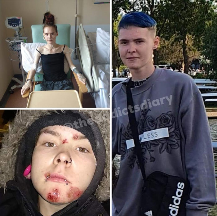 ‘The Addict’s Diary’ Showcases Before & After Transformations Of People Who Quit Drugs (30 Stories) ‘The Addict’s Diary’ Showcases Before & After Transformations Of People Who Quit Drugs (30 Stories)