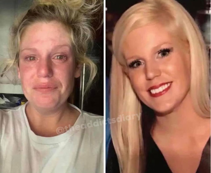 ‘The Addict’s Diary’ Showcases Before & After Transformations Of People Who Quit Drugs (30 Stories) ‘The Addict’s Diary’ Showcases Before & After Transformations Of People Who Quit Drugs (30 Stories)