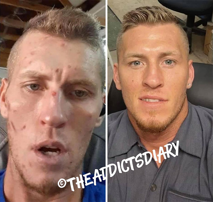 ‘The Addict’s Diary’ Showcases Before & After Transformations Of People Who Quit Drugs (30 Stories) ‘The Addict’s Diary’ Showcases Before & After Transformations Of People Who Quit Drugs (30 Stories)