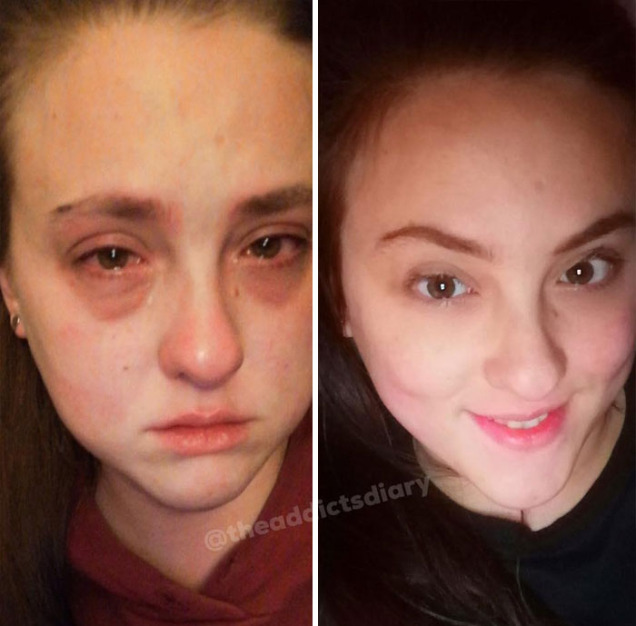 ‘The Addict’s Diary’ Showcases Before & After Transformations Of People Who Quit Drugs (30 Stories) ‘The Addict’s Diary’ Showcases Before & After Transformations Of People Who Quit Drugs (30 Stories)