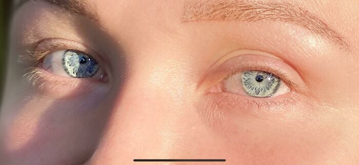 50 Photos Of Unique People’s Features Because Of Their Rare Genetics (New Pics) 50 Photos Of Unique People’s Features Because Of Their Rare Genetics (New Pics)