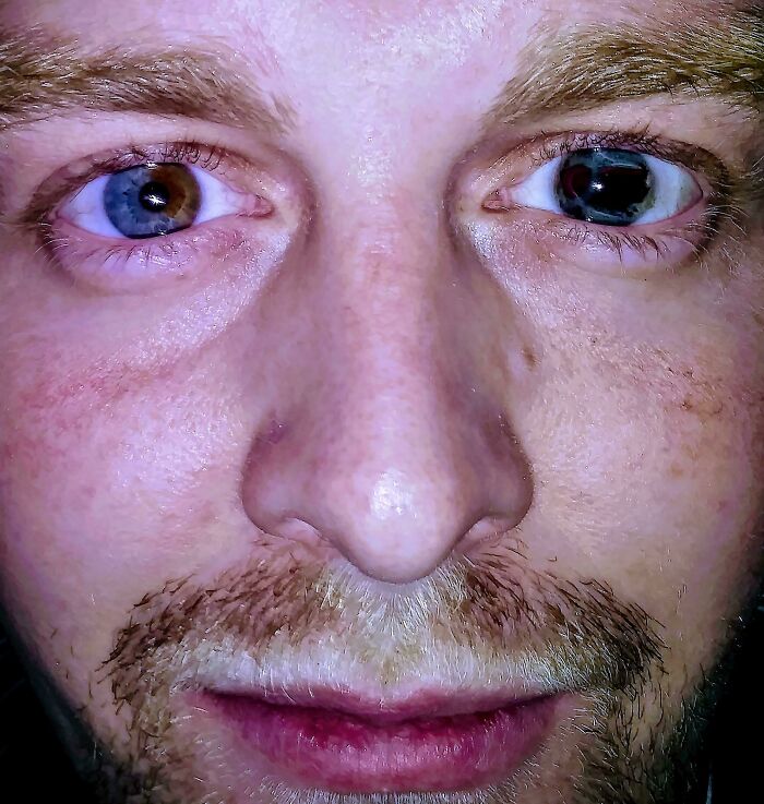 50 Photos Of Unique People’s Features Because Of Their Rare Genetics (New Pics) 50 Photos Of Unique People’s Features Because Of Their Rare Genetics (New Pics)