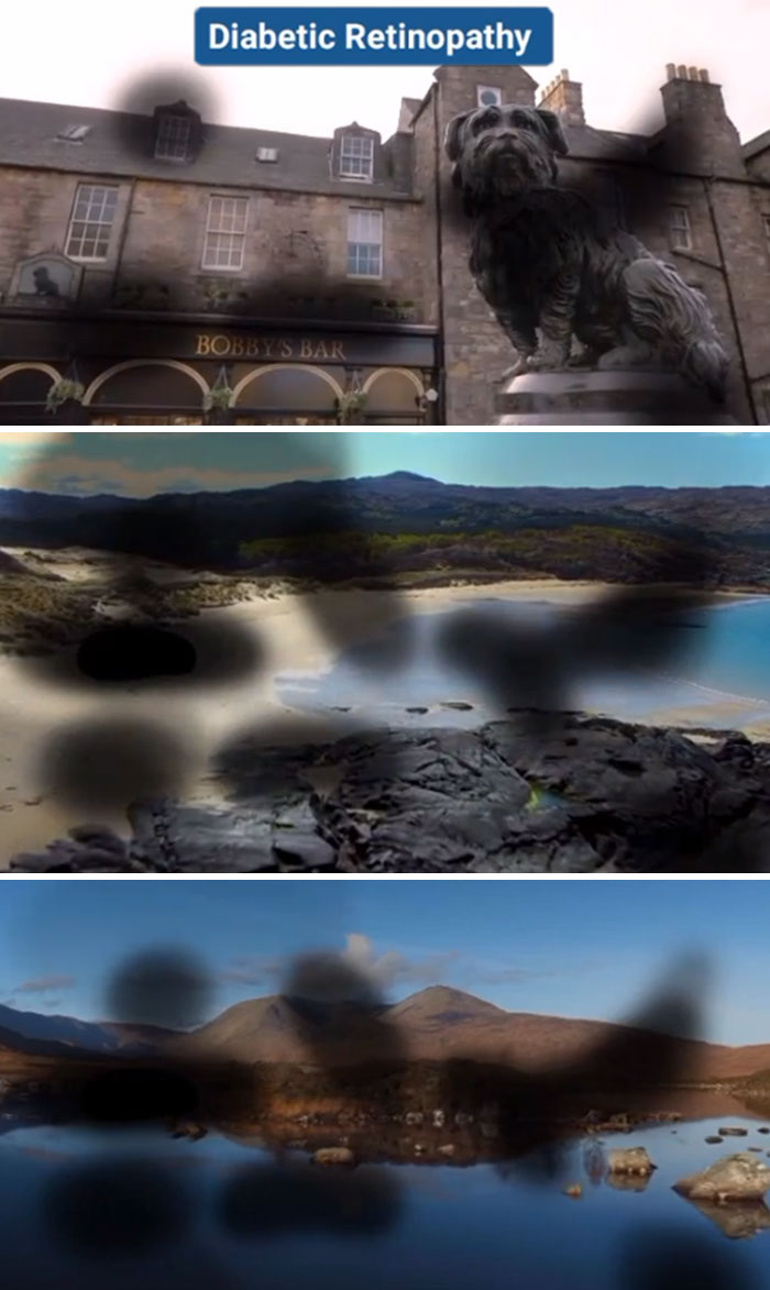 Medical Student Shows How People With Certain Medical Conditions See (19 Pics) Medical Student Shows How People With Certain Medical Conditions See (19 Pics)