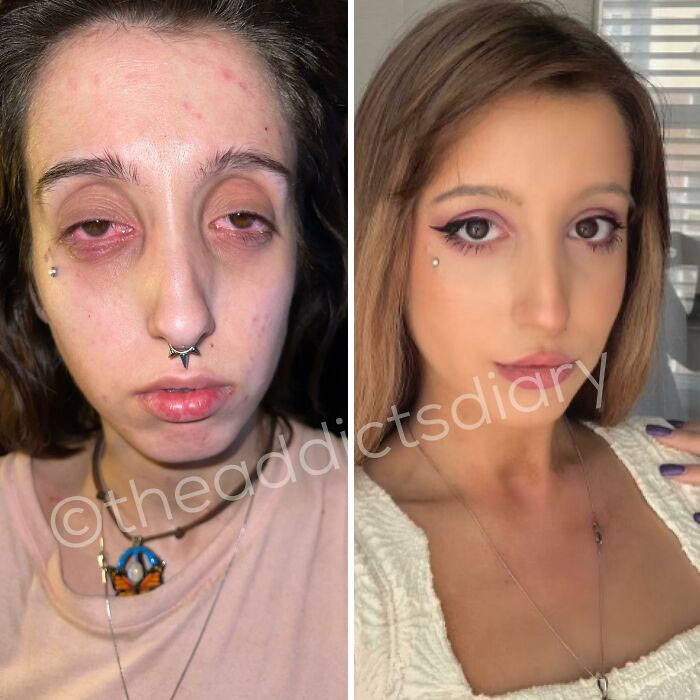 ‘The Addict’s Diary’: 30 Powerful Before & After Transformations Of Drug Addicts (New Stories) ‘The Addict’s Diary’: 30 Powerful Before & After Transformations Of Drug Addicts (New Stories)