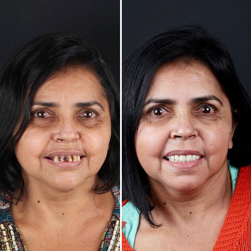 Brazilian Dentist Travels To Treat The Teeth Of Poor People For Free And Here Are 30 Transformations Brazilian Dentist Travels To Treat The Teeth Of Poor People For Free And Here Are 30 Transformations