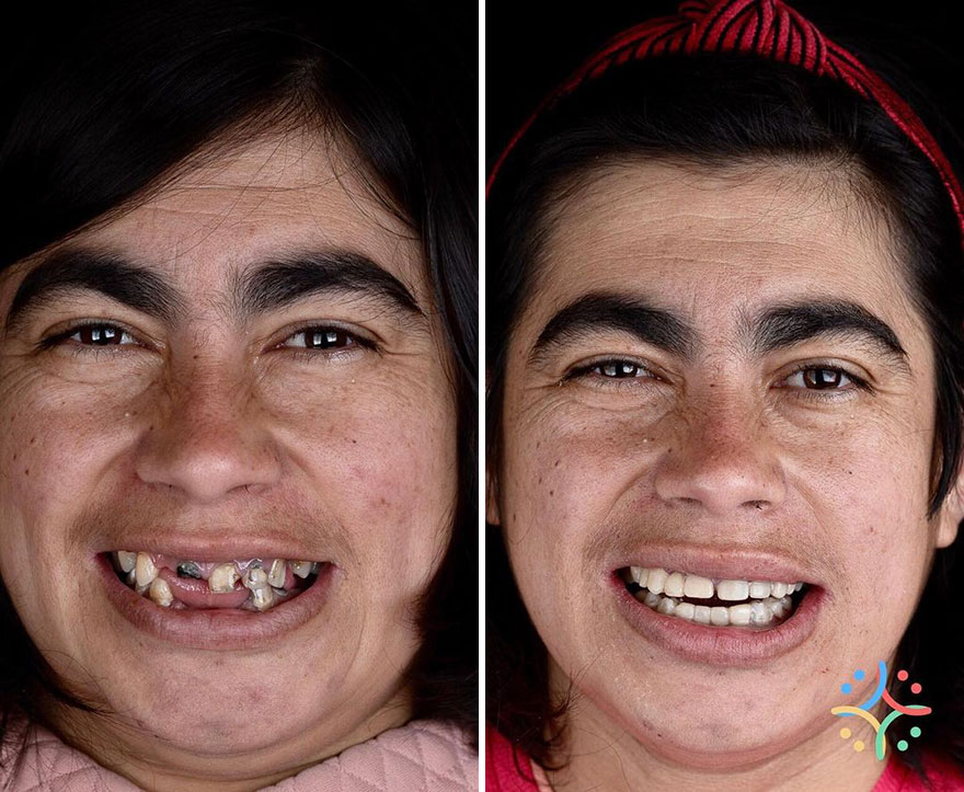 Brazilian Dentist Travels To Treat The Teeth Of Poor People For Free And Here Are 30 Transformations Brazilian Dentist Travels To Treat The Teeth Of Poor People For Free And Here Are 30 Transformations