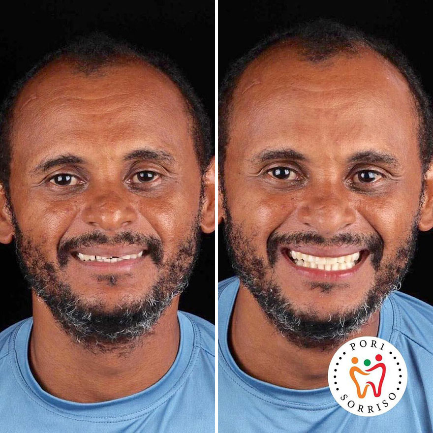 Brazilian Dentist Travels To Treat The Teeth Of Poor People For Free And Here Are 30 Transformations Brazilian Dentist Travels To Treat The Teeth Of Poor People For Free And Here Are 30 Transformations