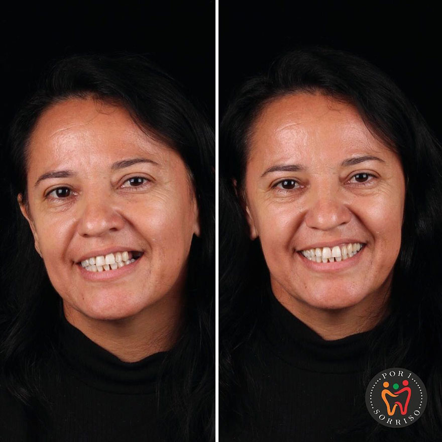 Brazilian Dentist Travels To Treat The Teeth Of Poor People For Free And Here Are 30 Transformations Brazilian Dentist Travels To Treat The Teeth Of Poor People For Free And Here Are 30 Transformations