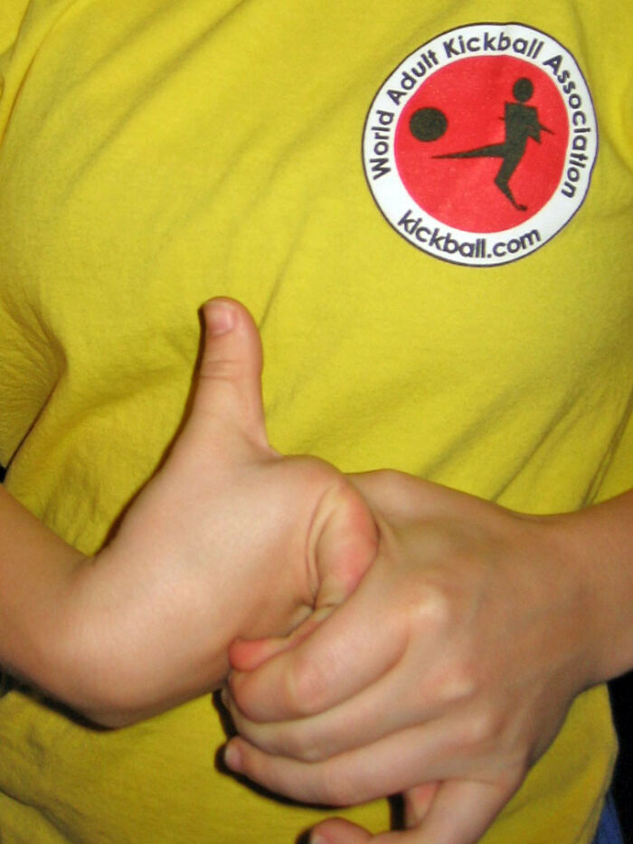 Only People With Rare Body Features Joined This Thread And Shared 35 Of Their Body Anomalies Only People With Rare Body Features Joined This Thread And Shared 35 Of Their Body Anomalies