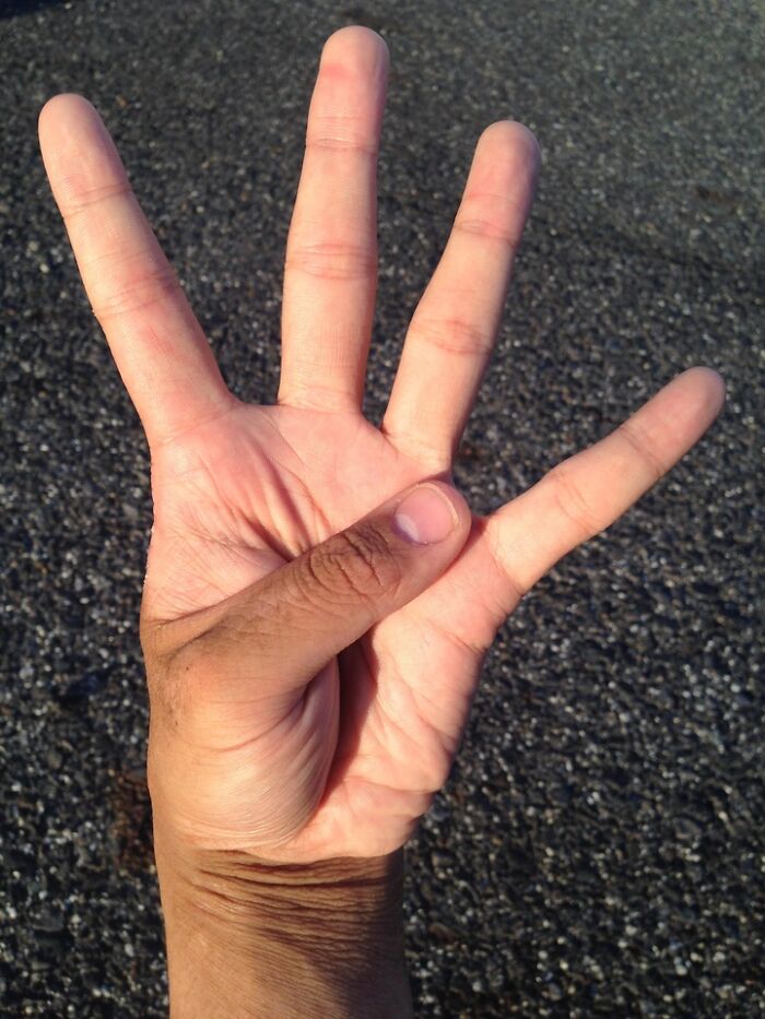 Only People With Rare Body Features Joined This Thread And Shared 35 Of Their Body Anomalies Only People With Rare Body Features Joined This Thread And Shared 35 Of Their Body Anomalies