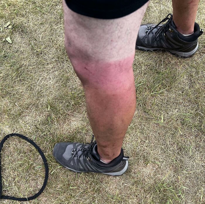 “I Don’t Need Sunscreen”: 50 People Who Thought So And Ended Up Looking Like Dorks (New Pics)