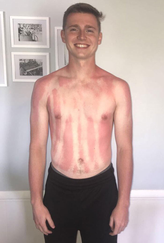 “I Don’t Need Sunscreen”: 50 People Who Thought So And Ended Up Looking Like Dorks (New Pics)