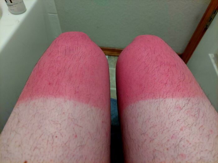“I Don’t Need Sunscreen”: 50 People Who Thought So And Ended Up Looking Like Dorks (New Pics)