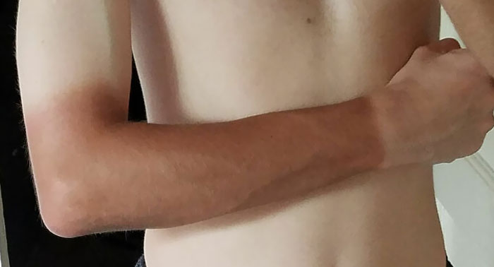 “I Don’t Need Sunscreen”: 50 People Who Thought So And Ended Up Looking Like Dorks (New Pics)