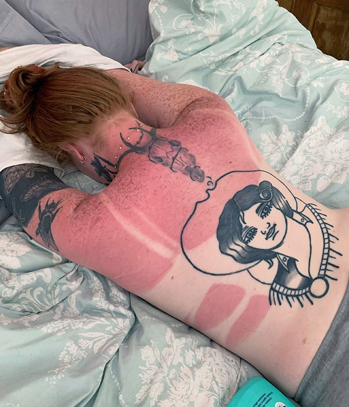 “I Don’t Need Sunscreen”: 50 People Who Thought So And Ended Up Looking Like Dorks (New Pics)