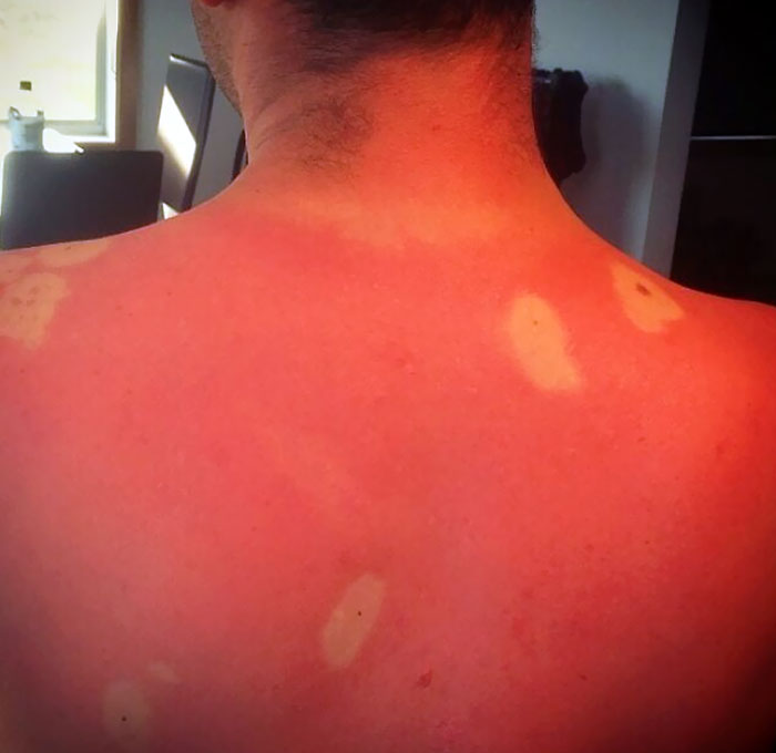 “I Don’t Need Sunscreen”: 50 People Who Thought So And Ended Up Looking Like Dorks (New Pics)