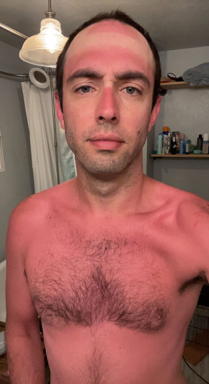 “I Don’t Need Sunscreen”: 50 People Who Thought So And Ended Up Looking Like Dorks (New Pics)