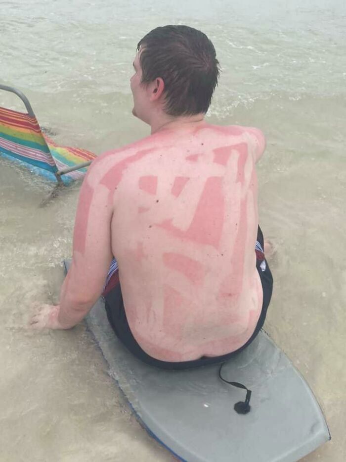 “I Don’t Need Sunscreen”: 50 People Who Thought So And Ended Up Looking Like Dorks (New Pics)