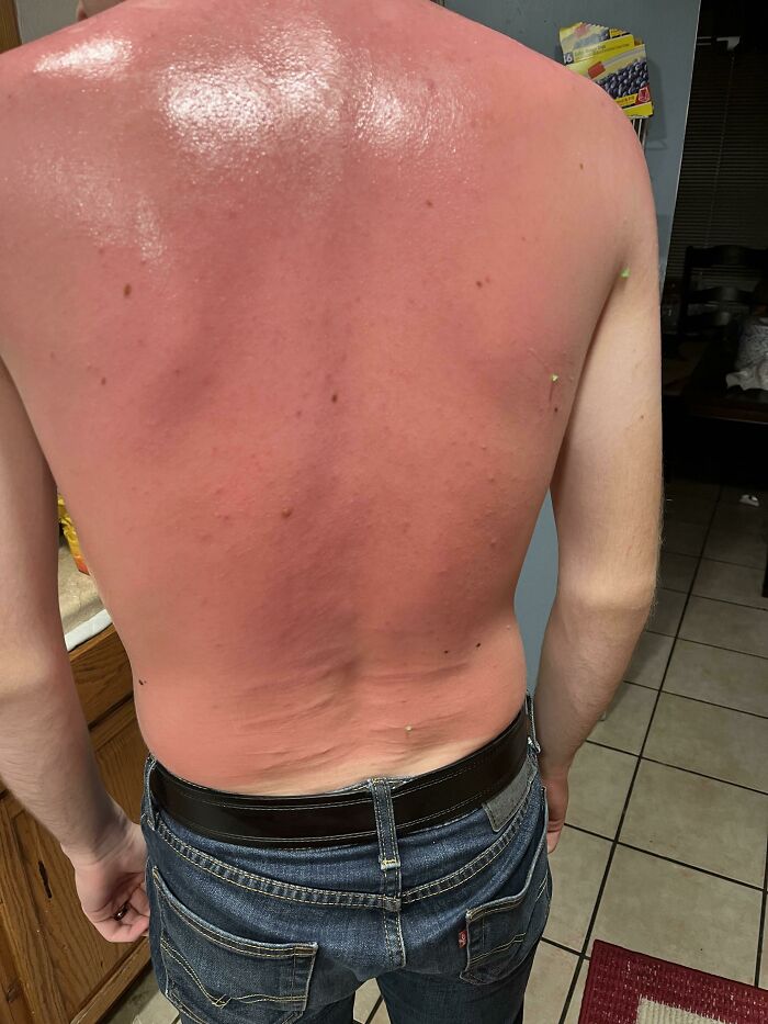 “I Don’t Need Sunscreen”: 50 People Who Thought So And Ended Up Looking Like Dorks (New Pics)