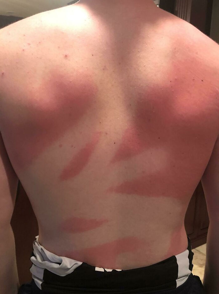 “I Don’t Need Sunscreen”: 50 People Who Thought So And Ended Up Looking Like Dorks (New Pics)