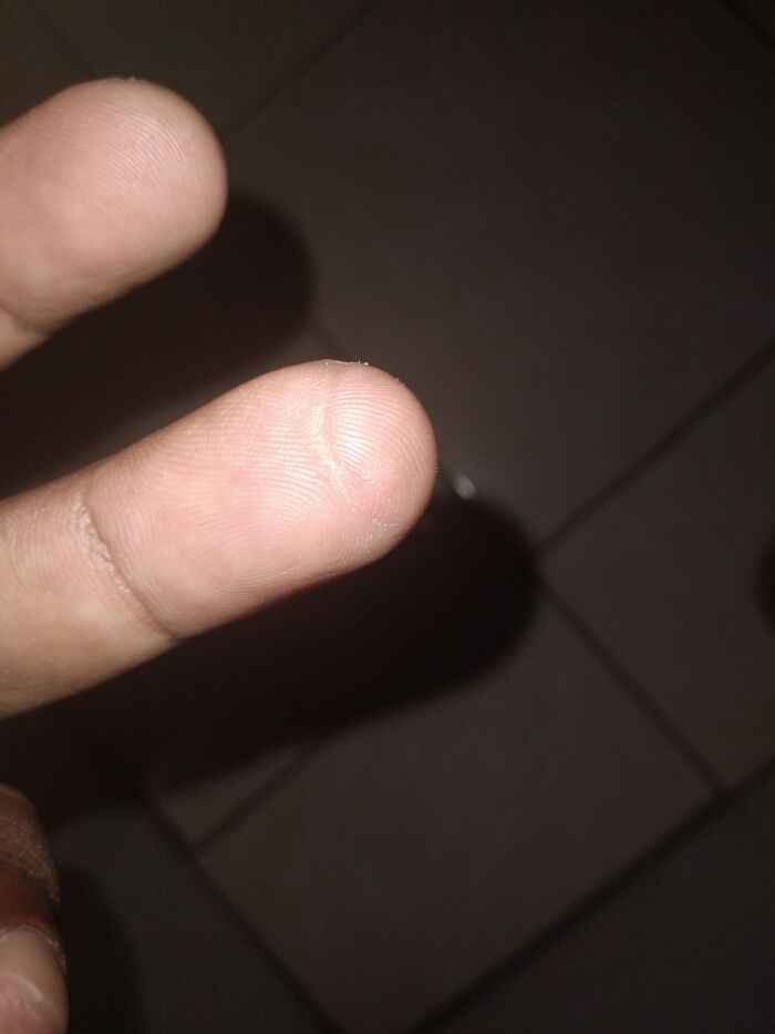 Hey Pandas, What Is Your Dumbest Scar And How Did You Get It? (Closed) Hey Pandas, What Is Your Dumbest Scar And How Did You Get It? (Closed)