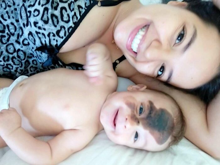 Societal Judgement Towards Enzo’s Mark On His Face Encouraged His Mom To Replicate It On Hers To Walk In His Shoes