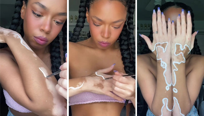 Woman Matches The Color Of The Paint She Outlines Her Vitiligo Spots With To Her Outfits, And People Can’t Get Enough Woman Matches The Color Of The Paint She Outlines Her Vitiligo Spots With To Her Outfits, And People Can’t Get Enough