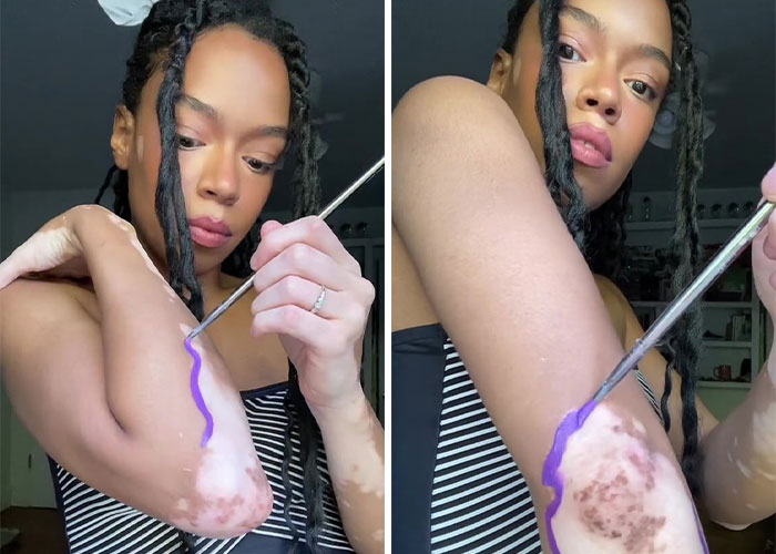 Woman Matches The Color Of The Paint She Outlines Her Vitiligo Spots With To Her Outfits, And People Can’t Get Enough Woman Matches The Color Of The Paint She Outlines Her Vitiligo Spots With To Her Outfits, And People Can’t Get Enough