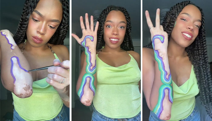 Woman Matches The Color Of The Paint She Outlines Her Vitiligo Spots With To Her Outfits, And People Can’t Get Enough Woman Matches The Color Of The Paint She Outlines Her Vitiligo Spots With To Her Outfits, And People Can’t Get Enough