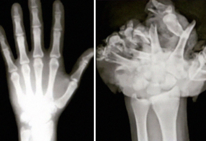 40 Bizarre And Inspiring Medical Cases That People Shared On This Online Community (New Pics) 40 Bizarre And Inspiring Medical Cases That People Shared On This Online Community (New Pics)
