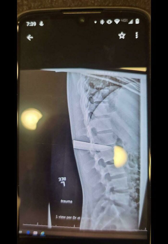 40 Bizarre And Inspiring Medical Cases That People Shared On This Online Community (New Pics) 40 Bizarre And Inspiring Medical Cases That People Shared On This Online Community (New Pics)