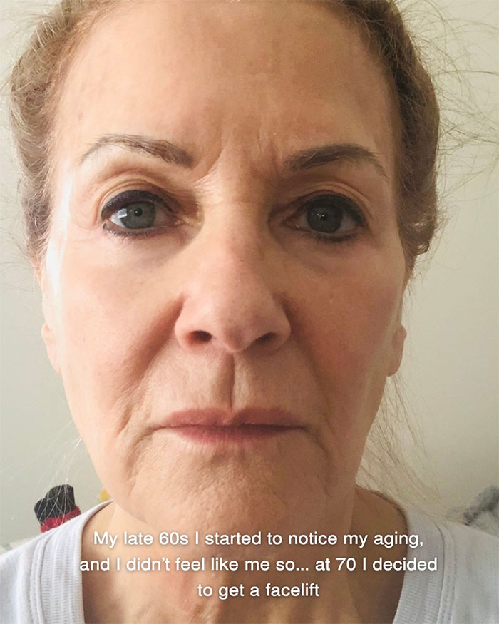 Woman Shares Her Aging Progress And How She Looks After Getting A Facelift At 70 Years Old Woman Shares Her Aging Progress And How She Looks After Getting A Facelift At 70 Years Old